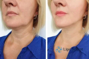 Double chin before and after Hi-Fu treatment 4 Book your double chin treatment Milton Keynes today! We are here to help!