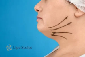 Double chin before and after Hi-Fu treatment 3 Boost your confidence with a Double chin treatment Milton Keynes