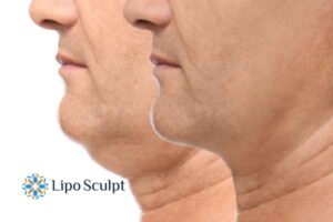 Double chin before and after Hi-Fu treatment 2 Double chin treatment Milton Keynes from Lipo Sculpt - feel more confident today!